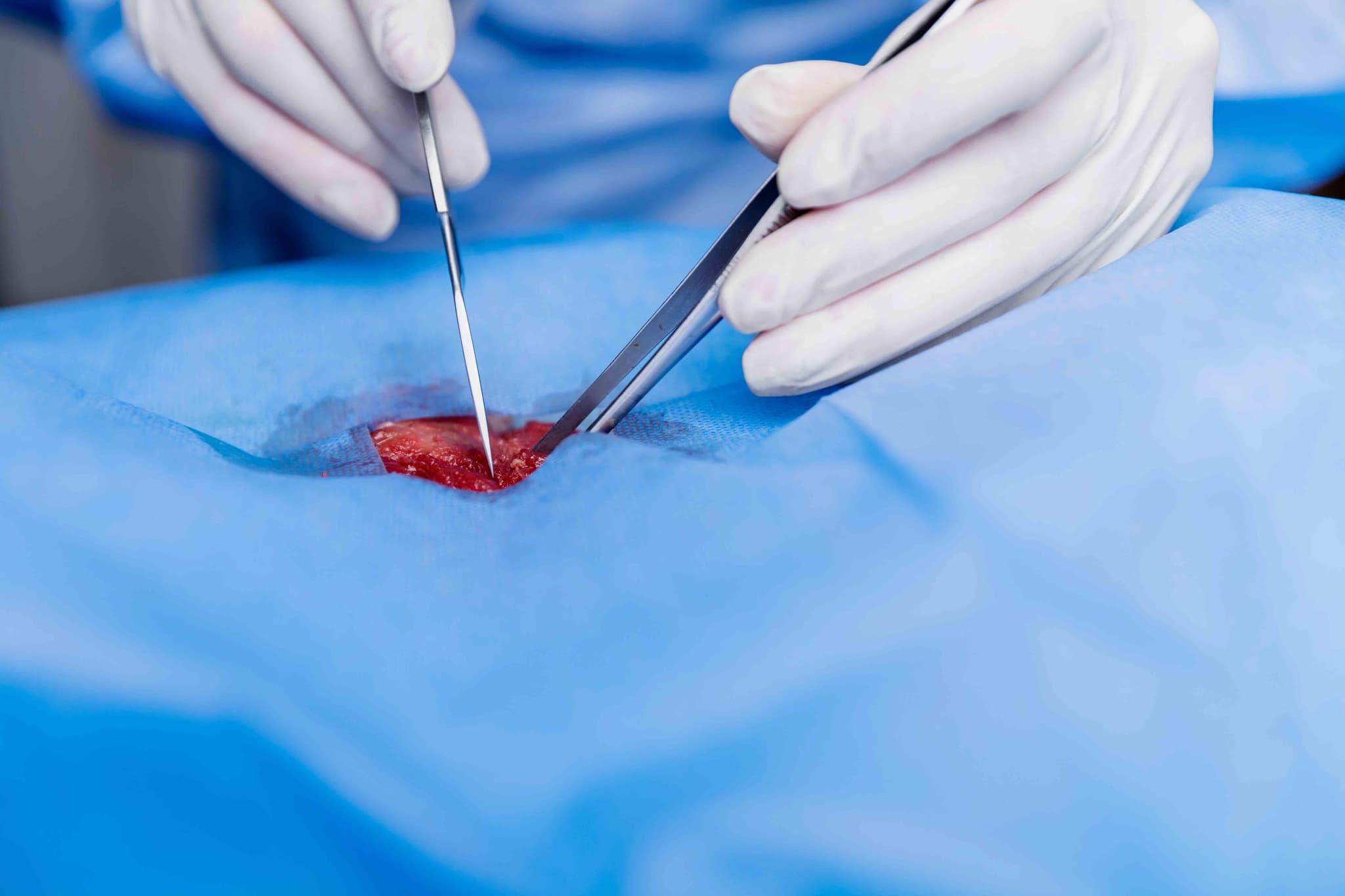 Endometrial Ablation hospital