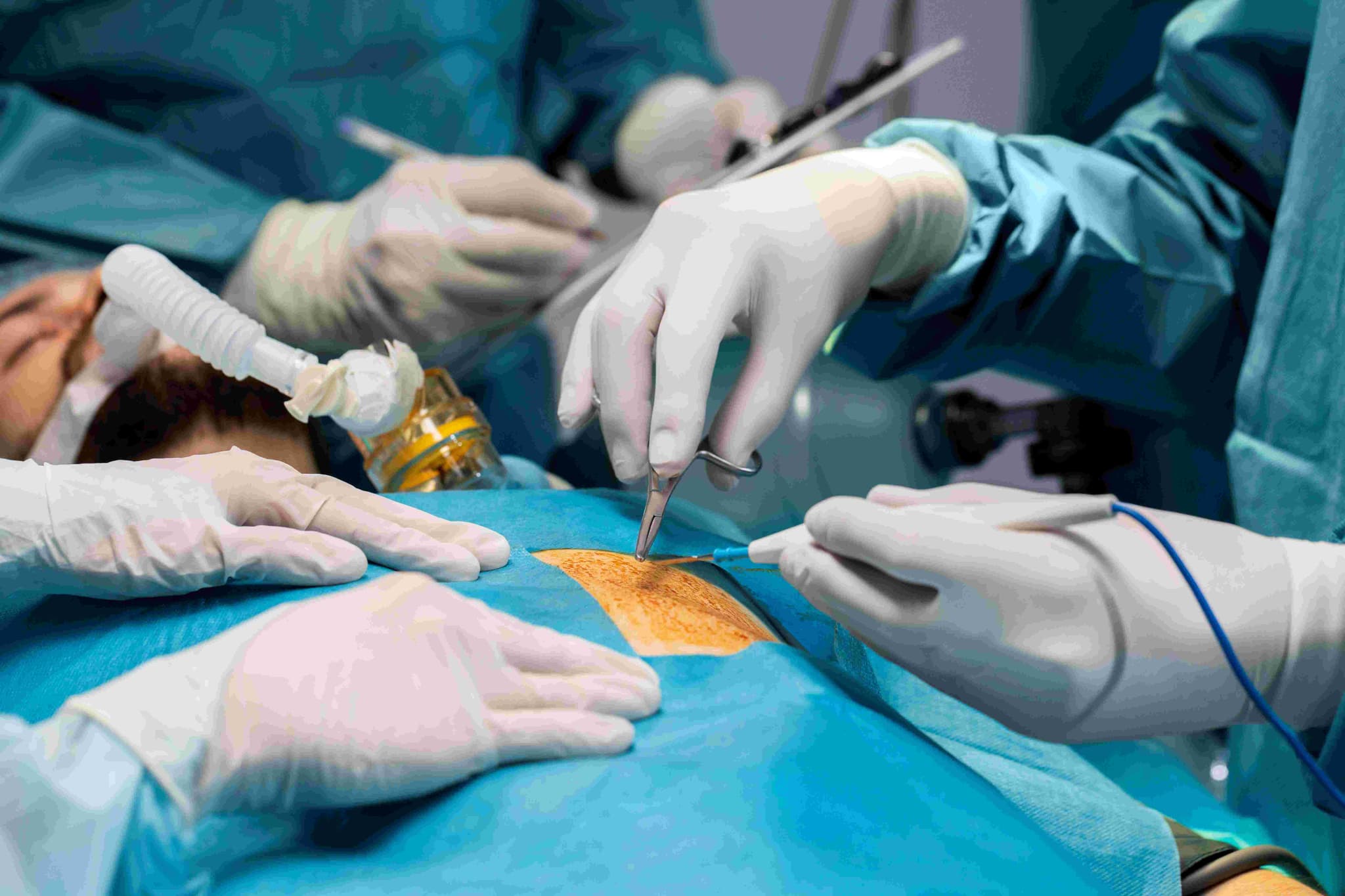 Laparoscopic Hernia Repair hospital