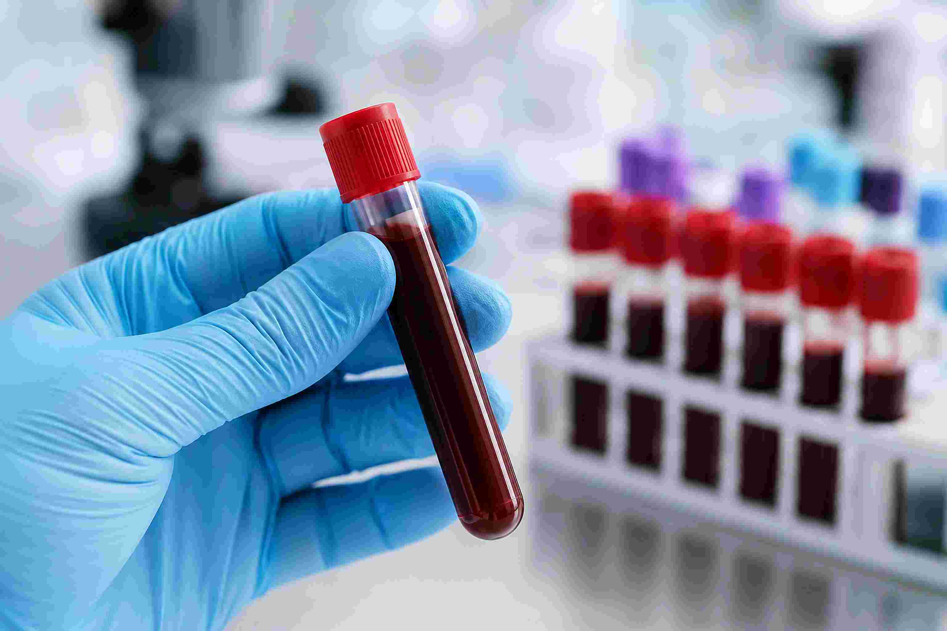 Thyroid Function Test (TFT)