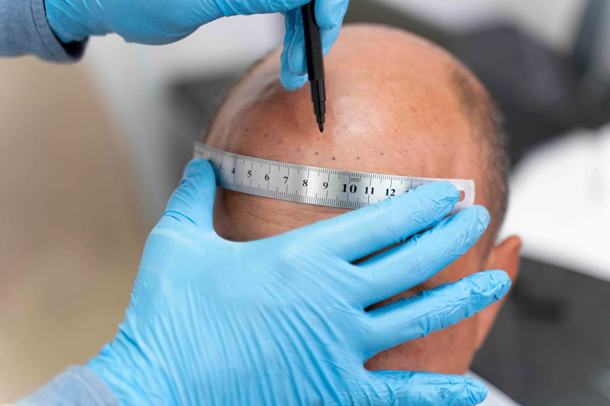 Scalp Micropigmentation hospital