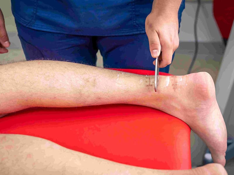 Peripheral Bypass Surgery (Leg arteries)
