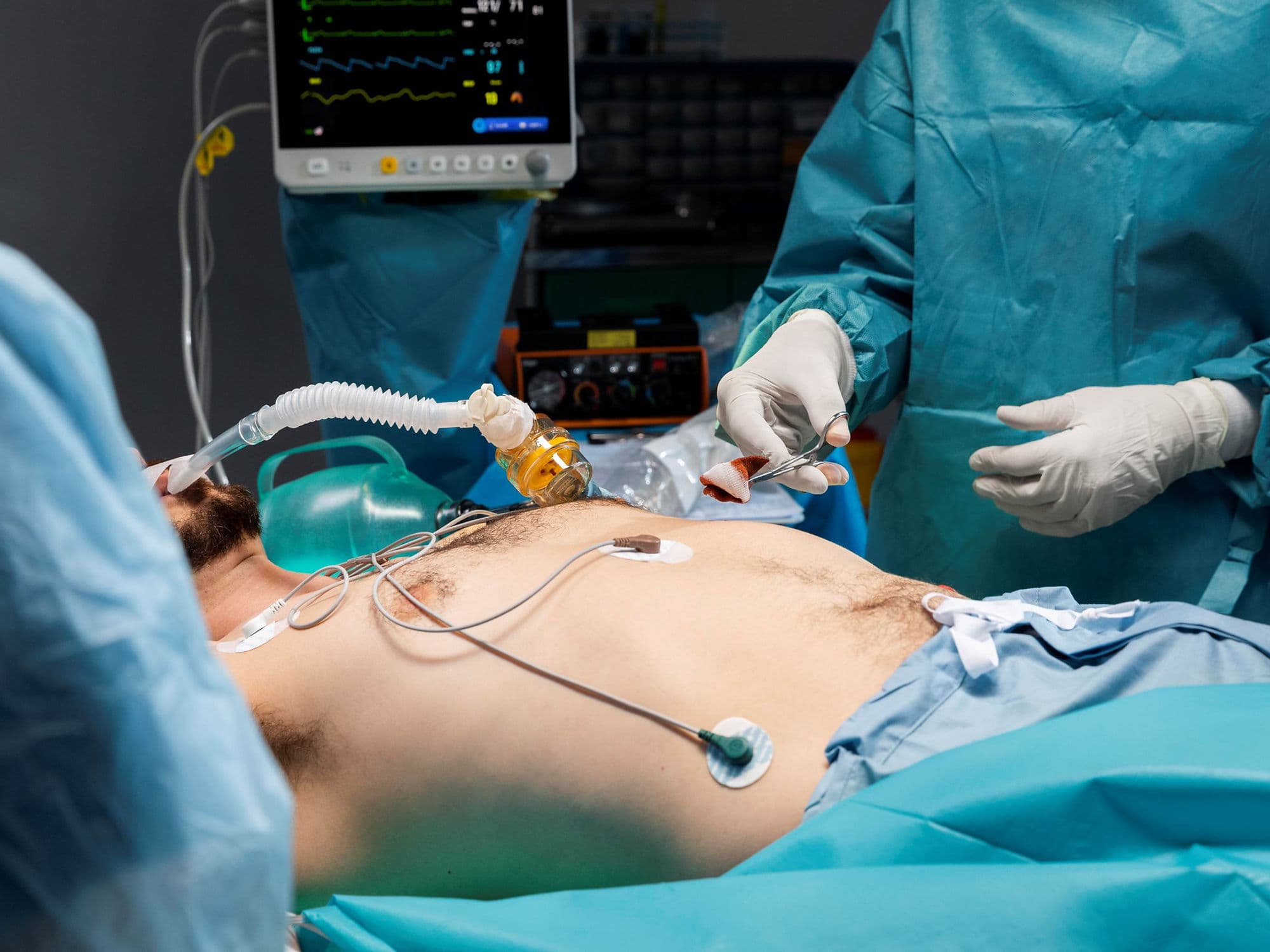 Appendectomy (Open/Laparoscopic) treatment