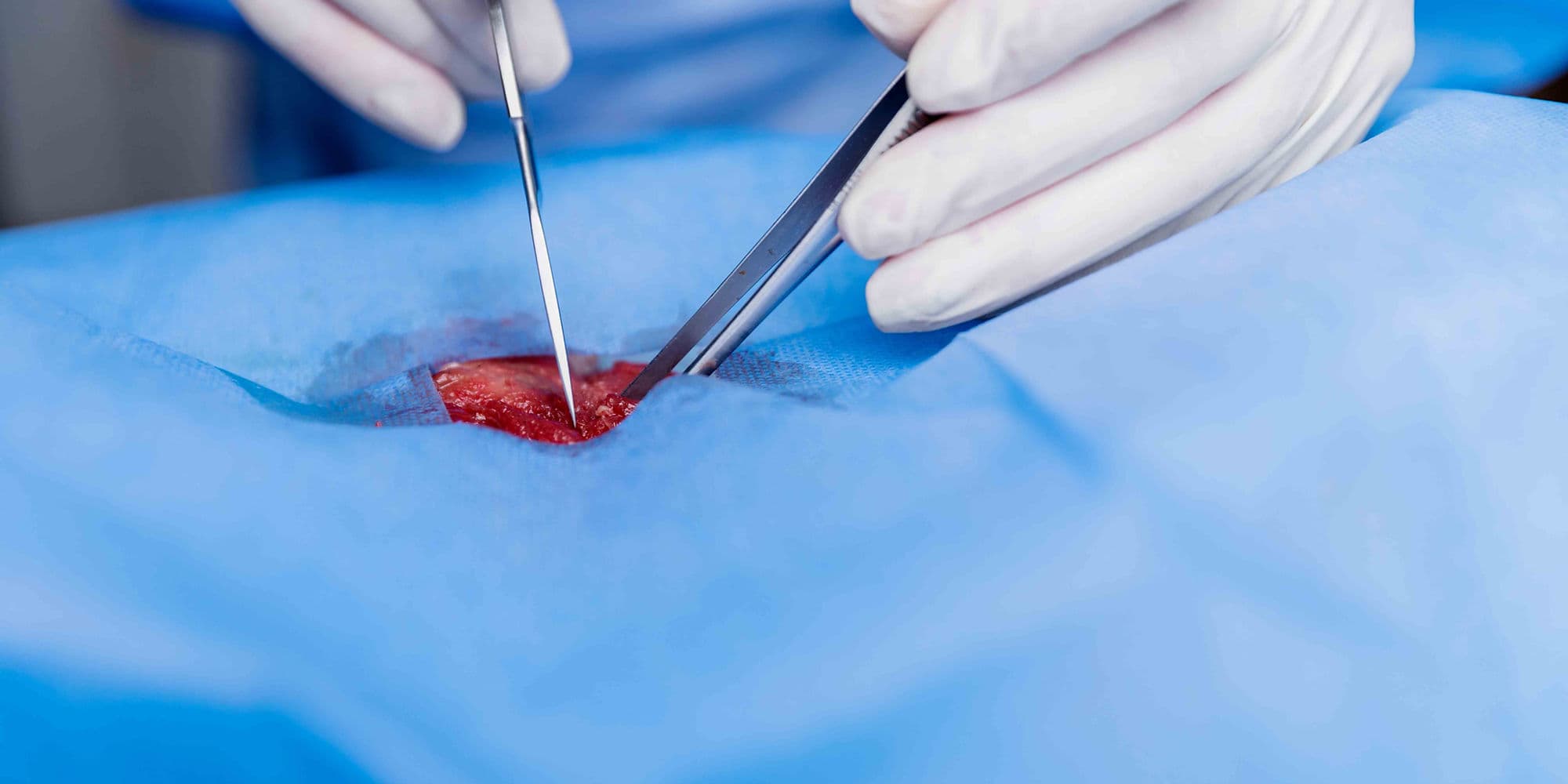 Endometrial Ablation treatment