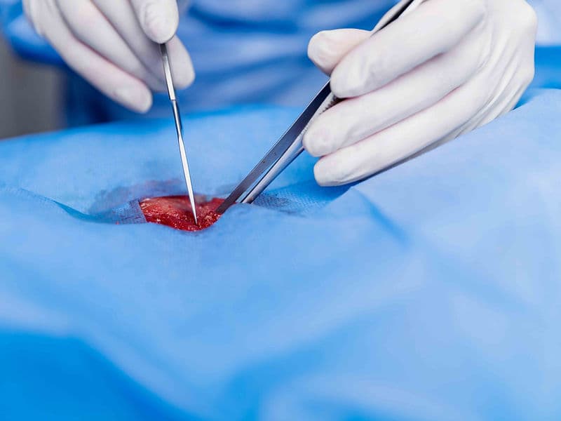 Endometrial Ablation