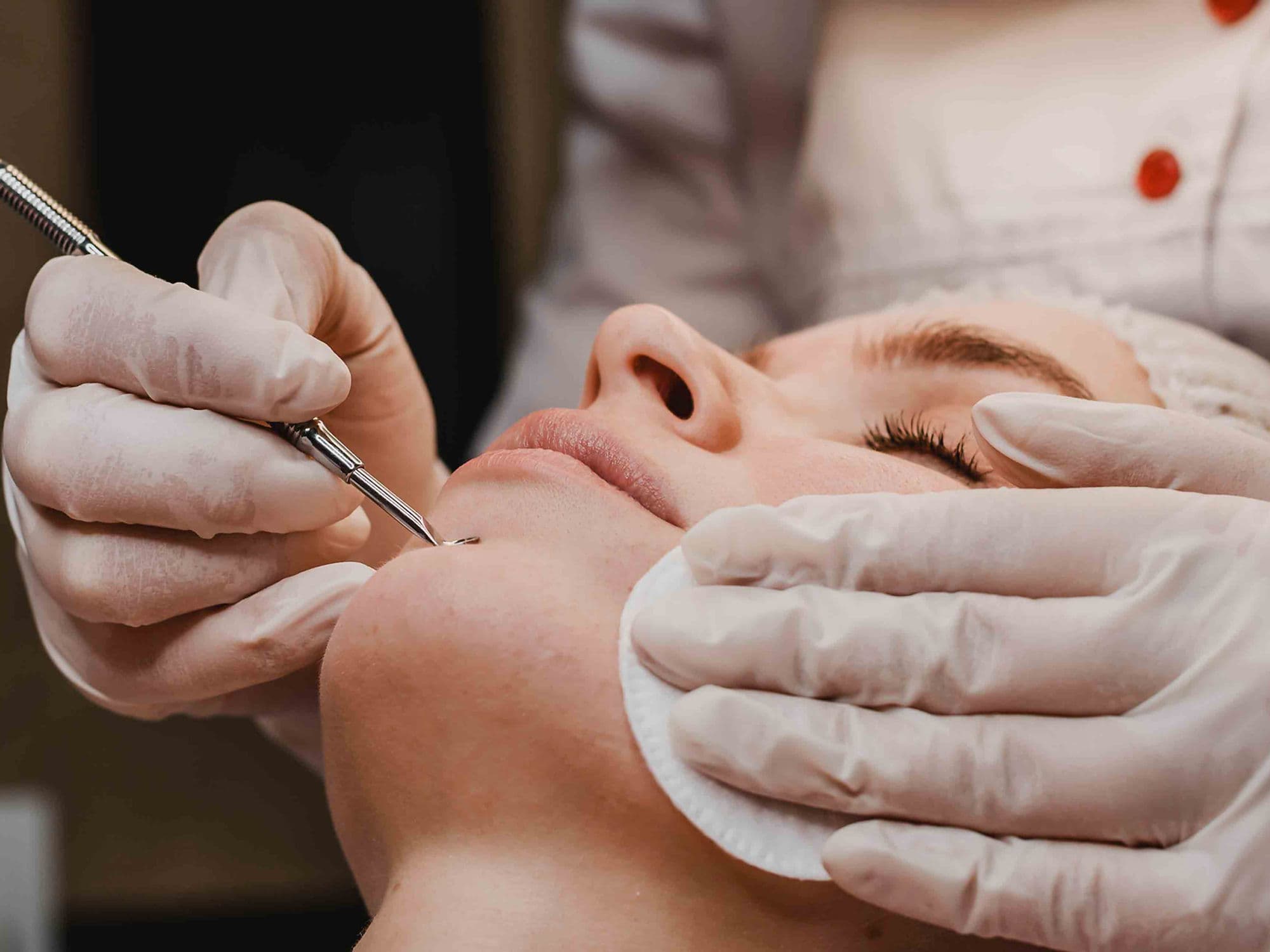 Mole Removal treatment