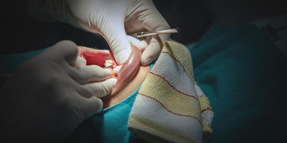 Polypectomy (Uterine Polyp Removal) treatment