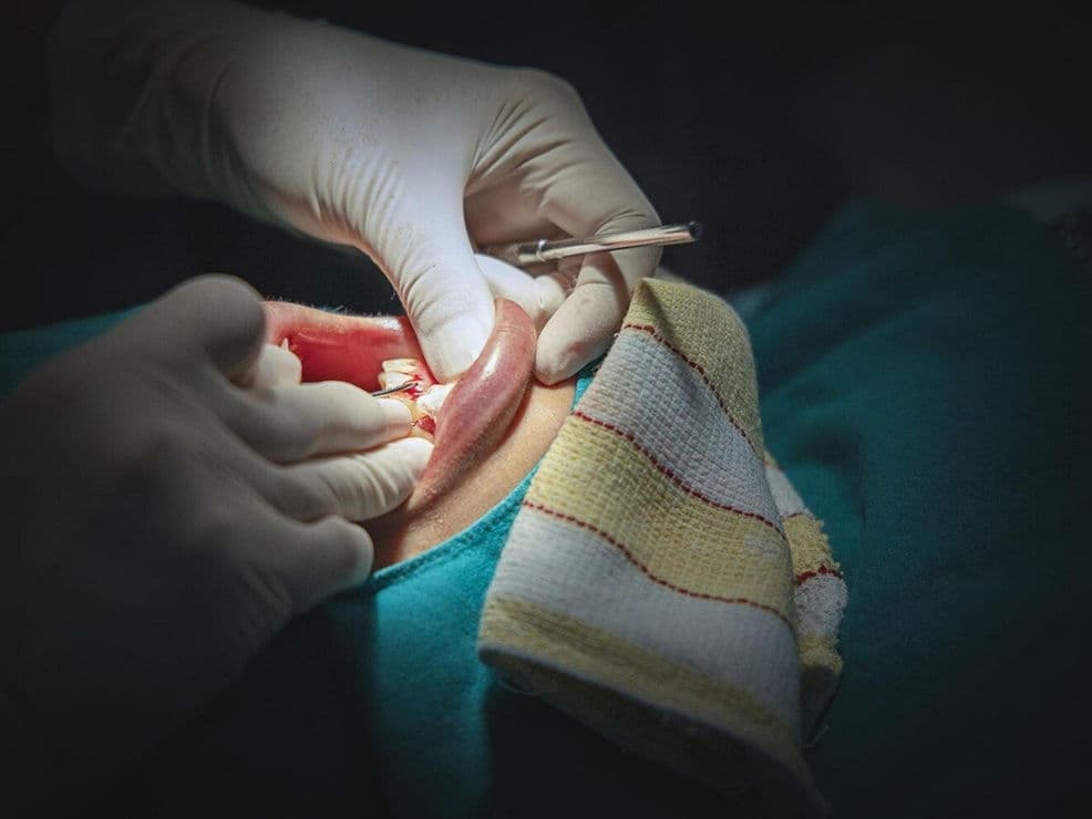 Polypectomy (Uterine Polyp Removal) treatment