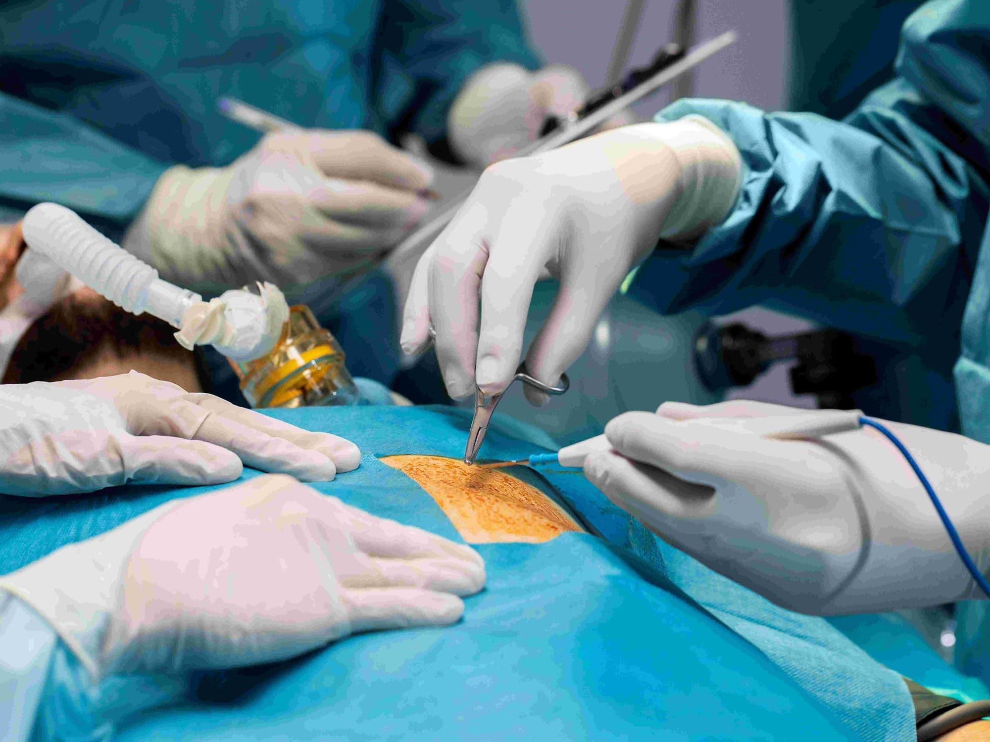 Laparoscopic Hernia Repair treatment
