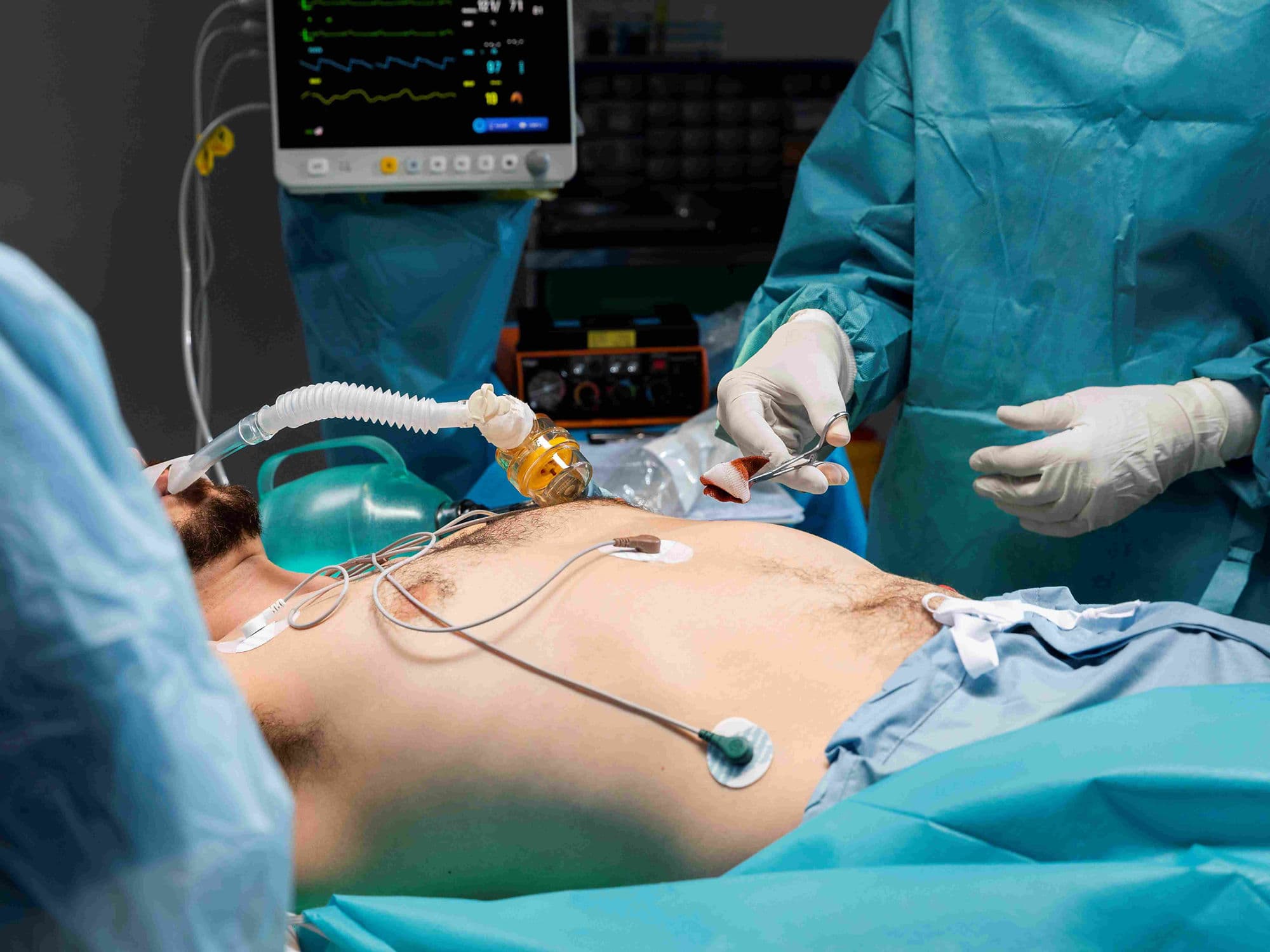 ECMO Cannulation treatment
