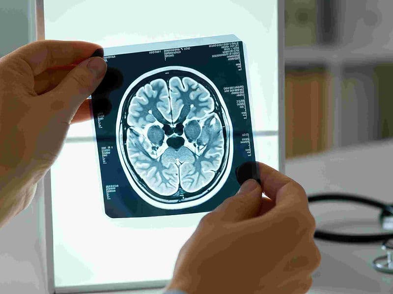 Aneurysm Clipping