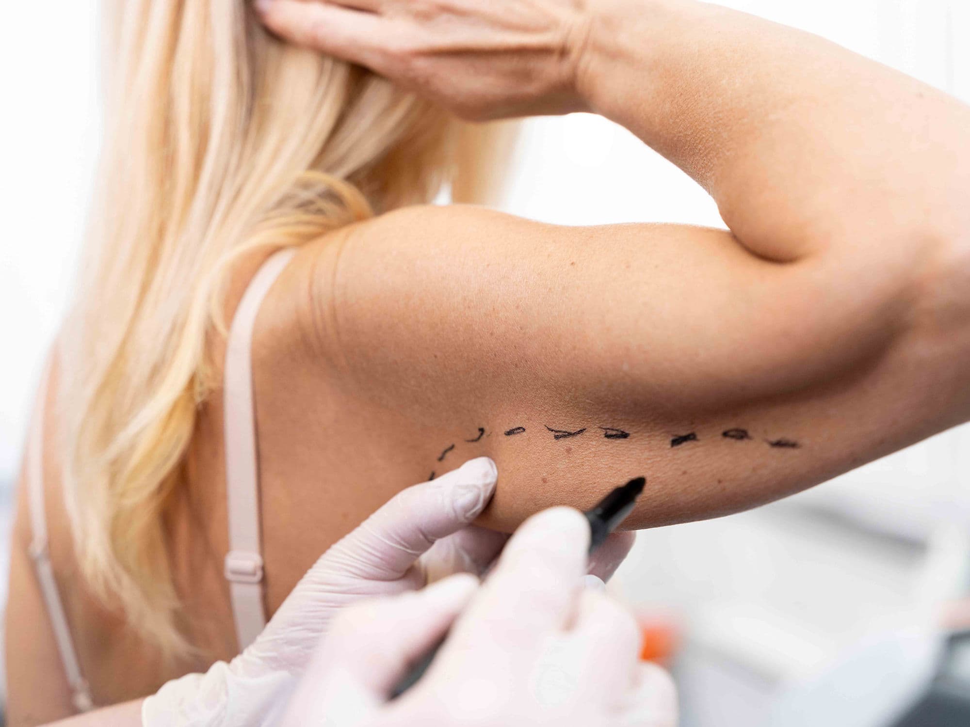 Arm Lift (Brachioplasty) treatment