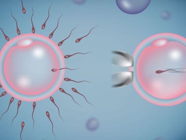 IVF with Intracytoplasmic Sperm Injection (ICSI) treatment