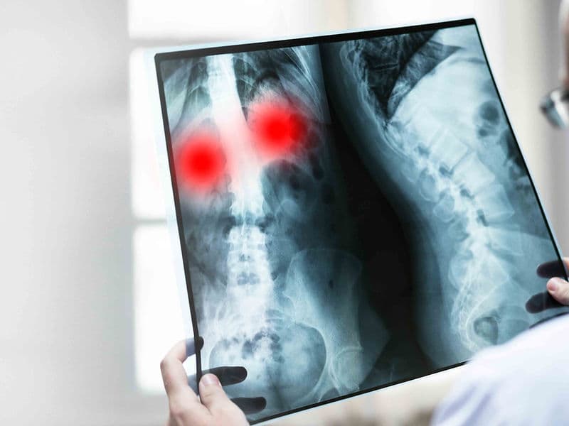 Spinal Tumor Removal